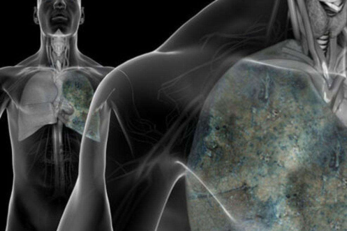 lung-cancer-s1-photo-of-lung-cancer